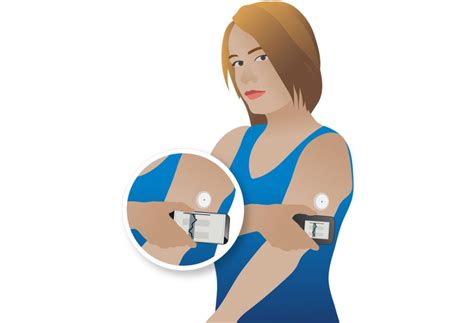Illustratie van een glucosesensor die op de arm is aangebracht, met pijlen die de meting van glucose in het weefselvocht aangeven.