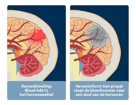 Illustratie van een gezonde en een aangetaste hersencel door alcoholgebruik