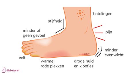 Illustratie van een gezwollen en rode grote teen, het typische symptoom van podagra