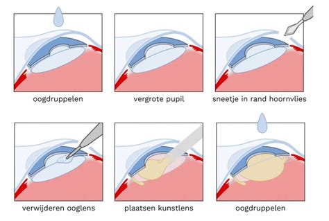 illustratie van een oog met een staaroperatie