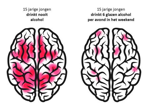 illustratie die de impact van alcohol op de hersenen toont